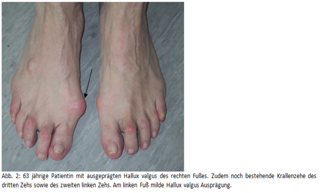 Hallux Valgus 2