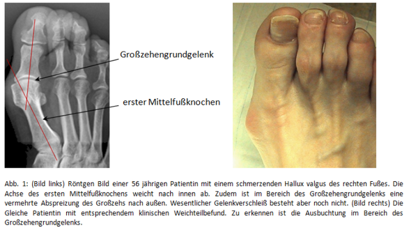 Hallux Valgus