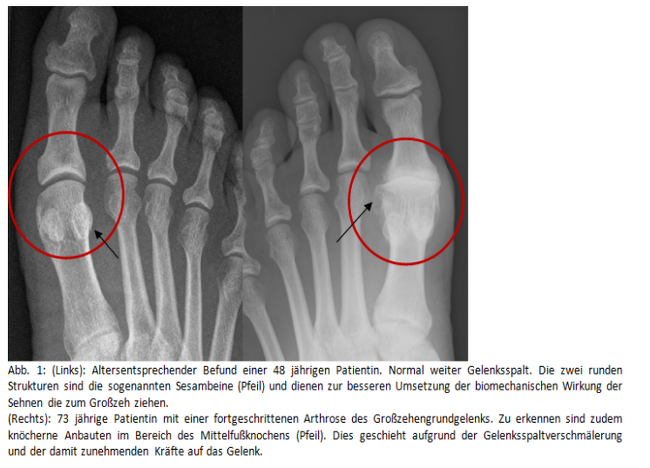 Hallux rigidus