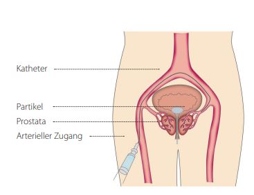 Prostataembolisation