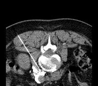 CT gesteuerte Therapie und Probengewinnung