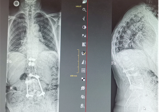 Wirbelsaeulen-Chirurgie Bild13