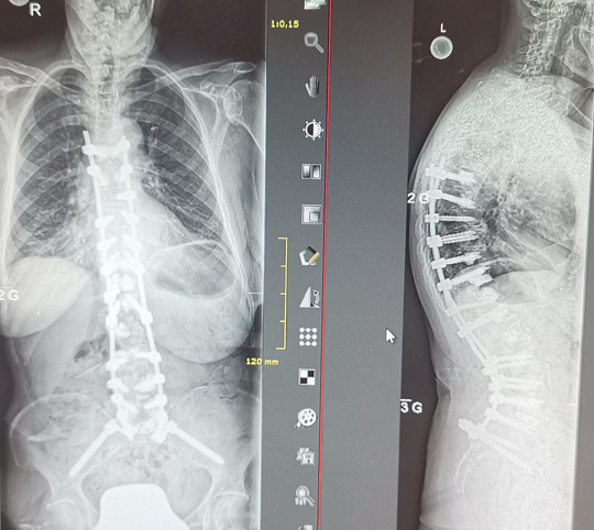 Wirbelsaeulen-Chirurgie Bild14