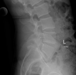 Wirbelsaeulen-Chirurgie Bild4a