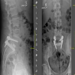 Wirbelsaeulen-Chirurgie Bild4b