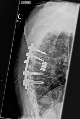 Wirbelsaeulen-Chirurgie Bild5a
