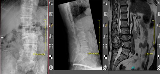 Wirbelsaeulen-Chirurgie Bild6