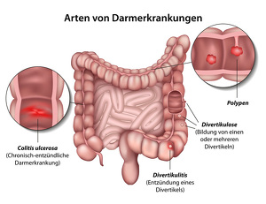 divertikel