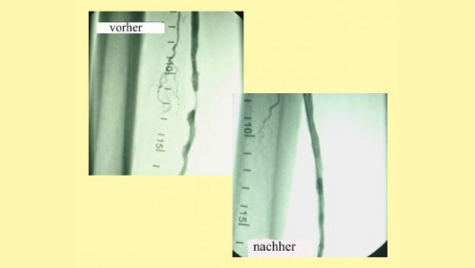 Arterielle Verschlußkrankheit